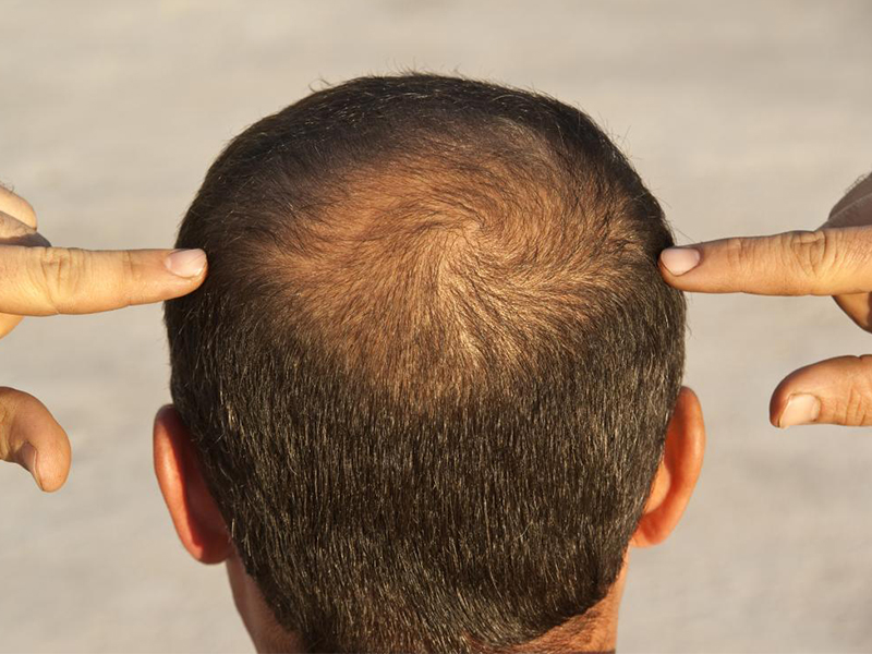 Hair Topper For Thinning Crown - The Ultimate Solution For Hair Loss