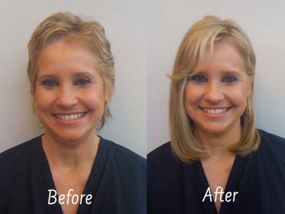 Hair Toppers Before And After Look At Its Pros And Cons 