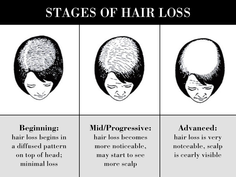 Stages of Hair Loss | Lewigs Human Hair