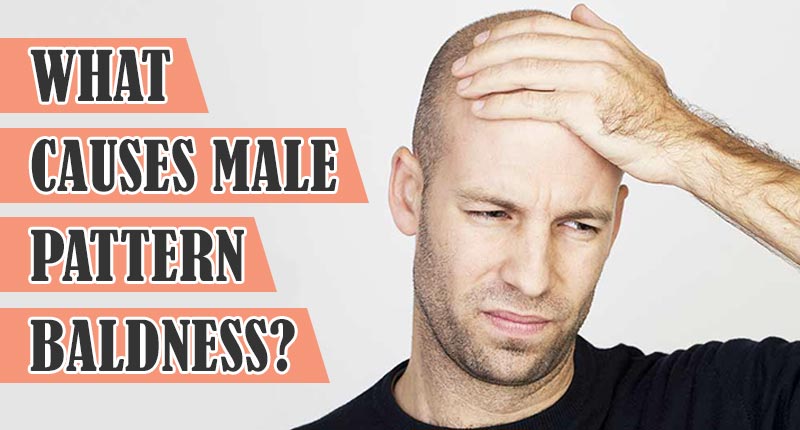 What Causes Male Pattern Baldness And How To Deal With It