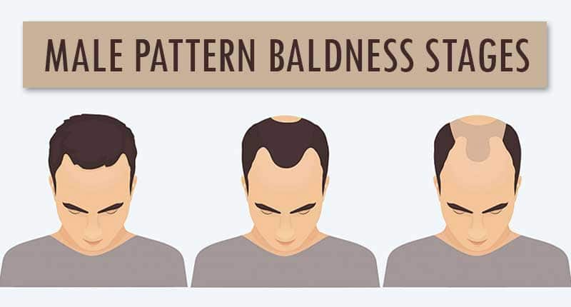 How Bald Are You? - Male Pattern Baldness Stages (Norwood Scale)