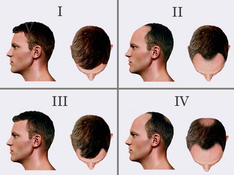 How Bald Are You? - Male Pattern Baldness Stages (Norwood Scale)