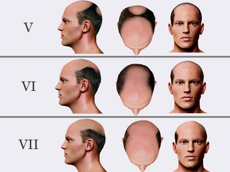 How Bald Are You? - Male Pattern Baldness Stages (Norwood Scale)