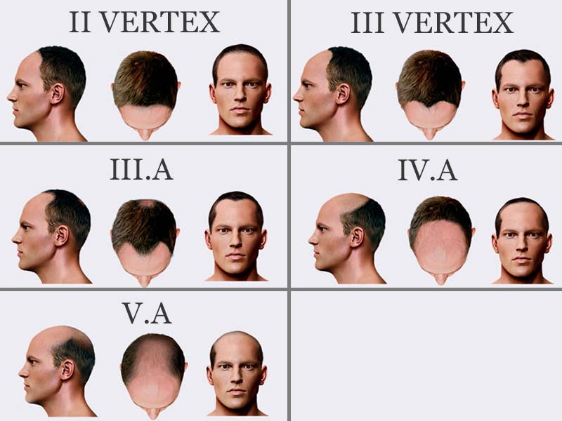 How Bald Are You? - Male Pattern Baldness Stages (Norwood Scale)