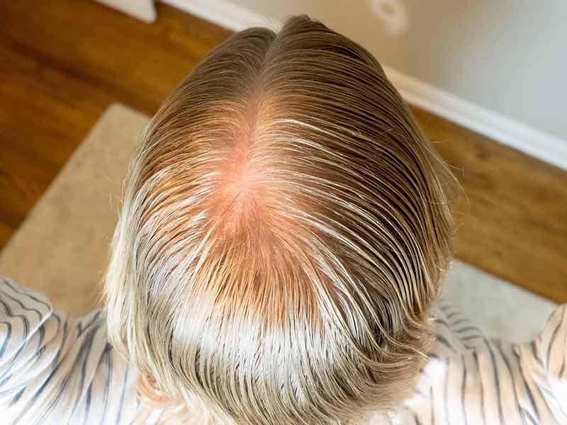 What Causes Gray Hair? The Real Reasons Revealed!