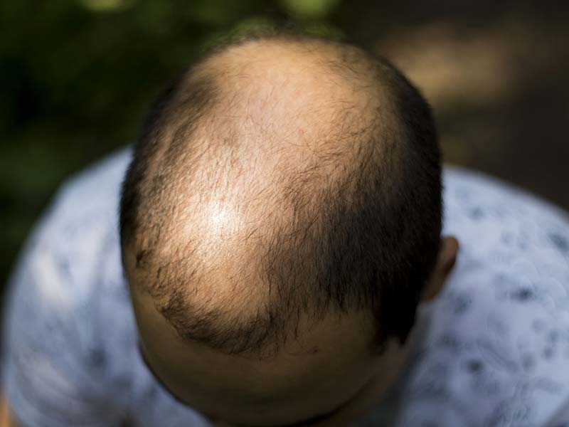 Is Male Pattern Baldness Cure Discovered Yet? - Hope vs. Reality