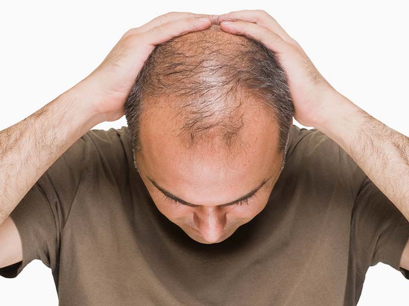 Is Male Pattern Baldness Cure Discovered Yet? - Hope vs. Reality