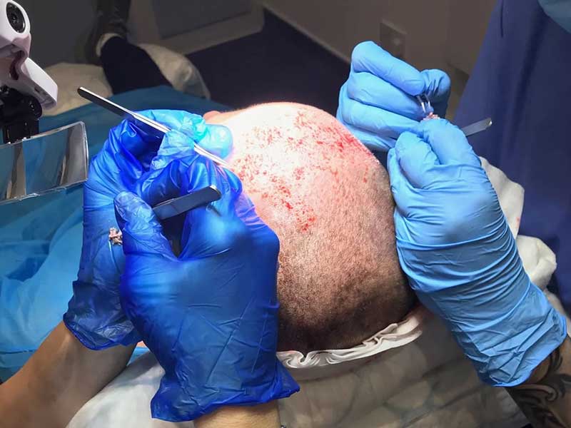 Is Hair Transplant Surgery Really Worth Trying?