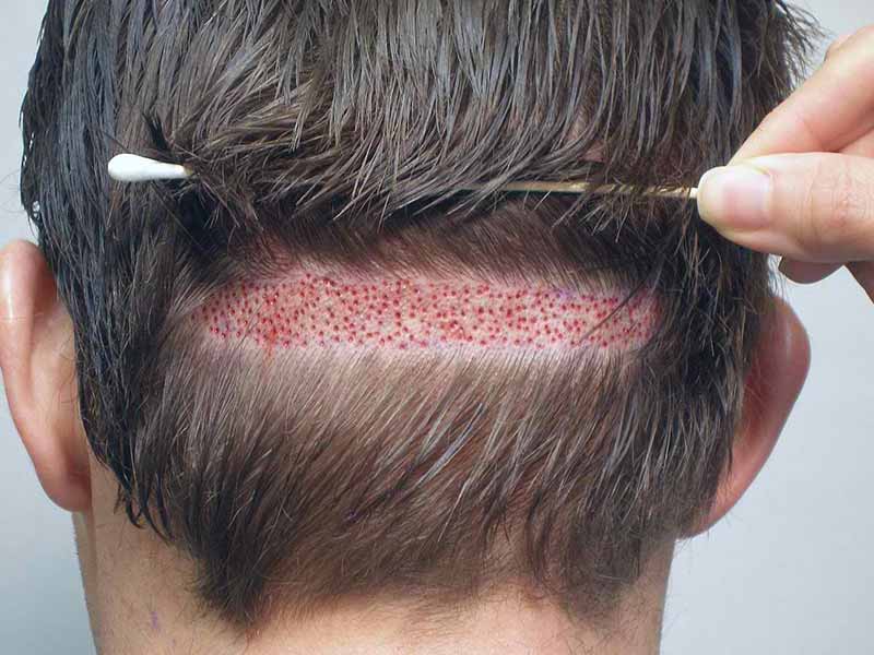 Is Hair Transplant Surgery Really Worth Trying?