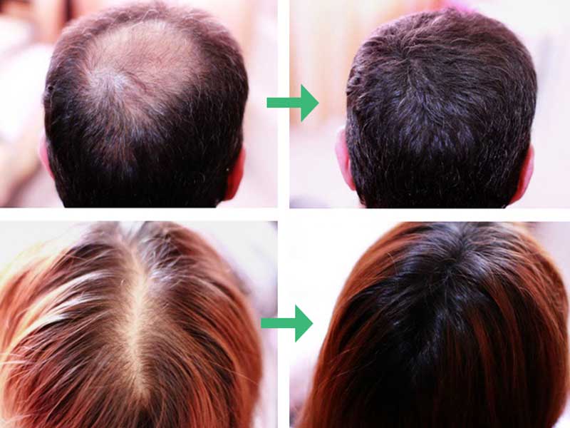 How To Reverse Hair Loss From Medication: The Easy Way Out