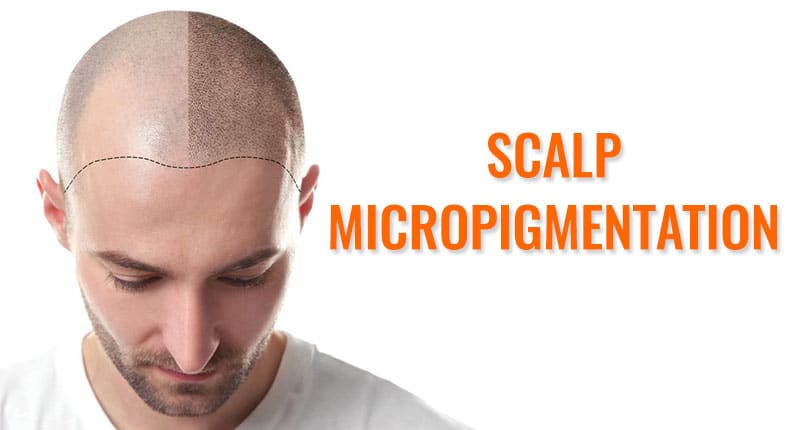 Scalp Micropigmentation Consulting – What The Heck Is That?