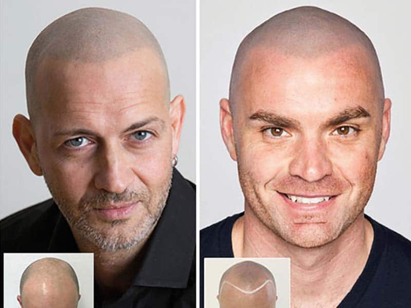 Scalp Micropigmentation Consulting – What The Heck Is That?