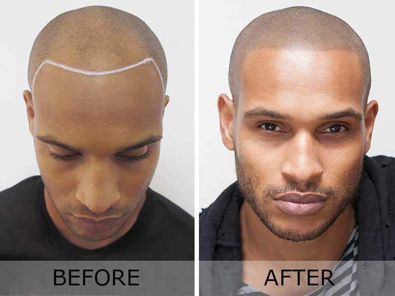 Scalp Micropigmentation Consulting – What The Heck Is That?