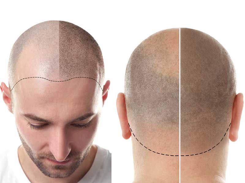 Scalp Micropigmentation Consulting – What The Heck Is That?