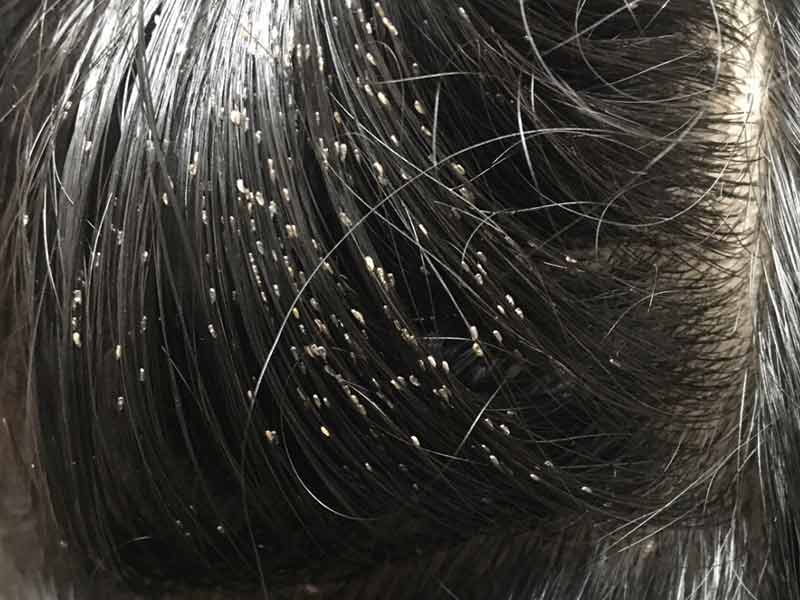 12 11 2 143 Lice Eggs On Human Hair LEWIGS 