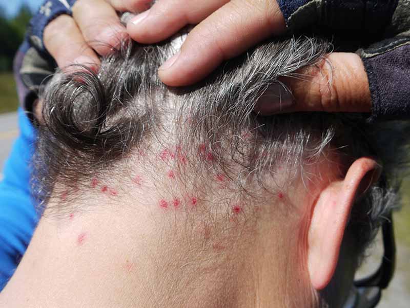 How To Tell If You Have Lice: Pay Attention To These 5 Signals!