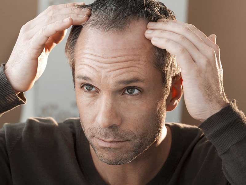 How Long Does It Take To Go Bald? - These Stats Are Real!