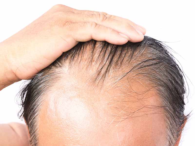 How Long Does It Take To Go Bald? - These Stats Are Real!