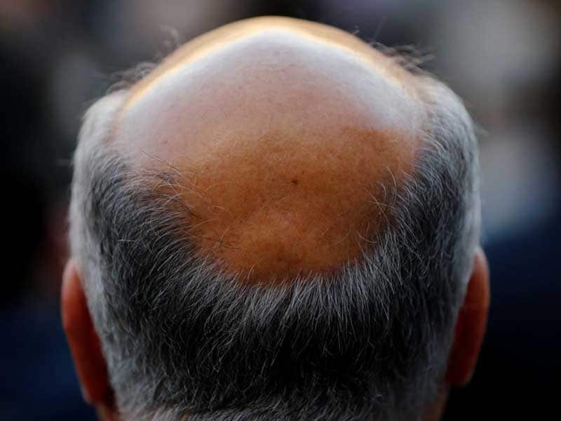 How Long Does It Take To Go Bald? - These Stats Are Real!