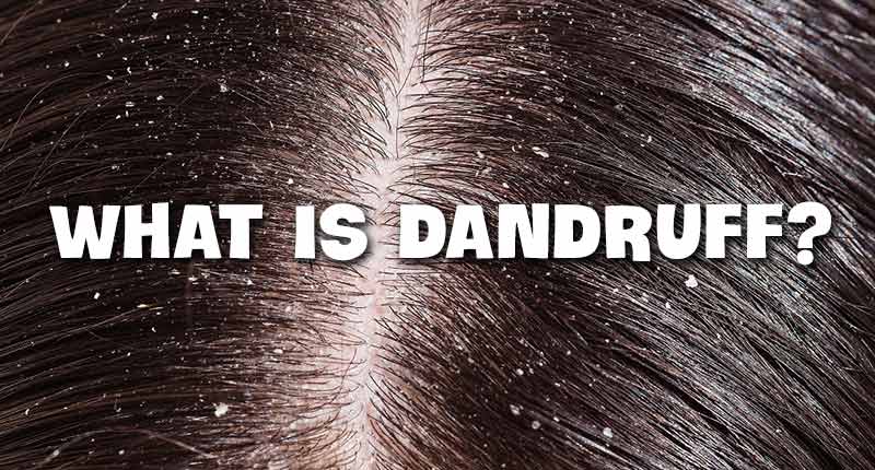 What Is Dandruff? - It's Not Like Snowflakes!