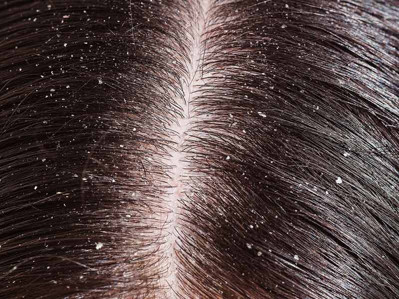 What Is Dandruff? - It's Not Like Snowflakes!