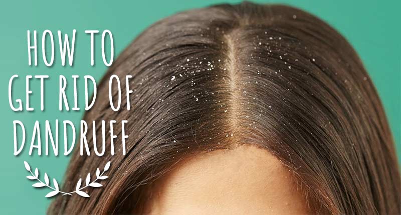 How To Get Rid Of Dandruff? - 9 Habits That May Help