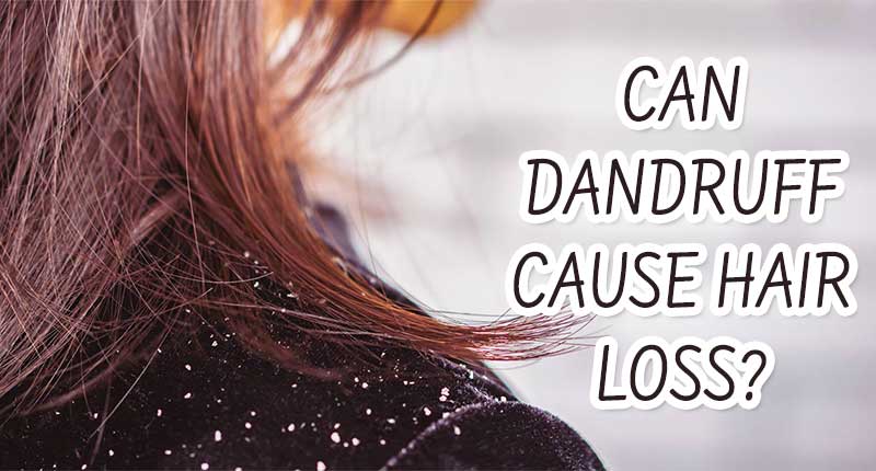 Can Dandruff Cause Hair Loss? Well... You Can Say 