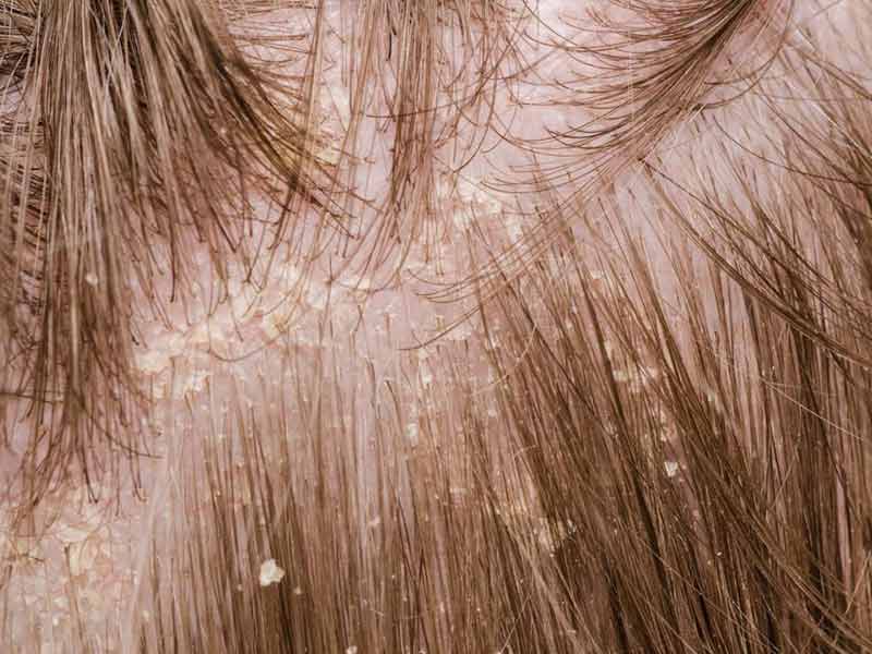 Can Dandruff Cause Hair Loss? Well... You Can Say "Yes" Or "No