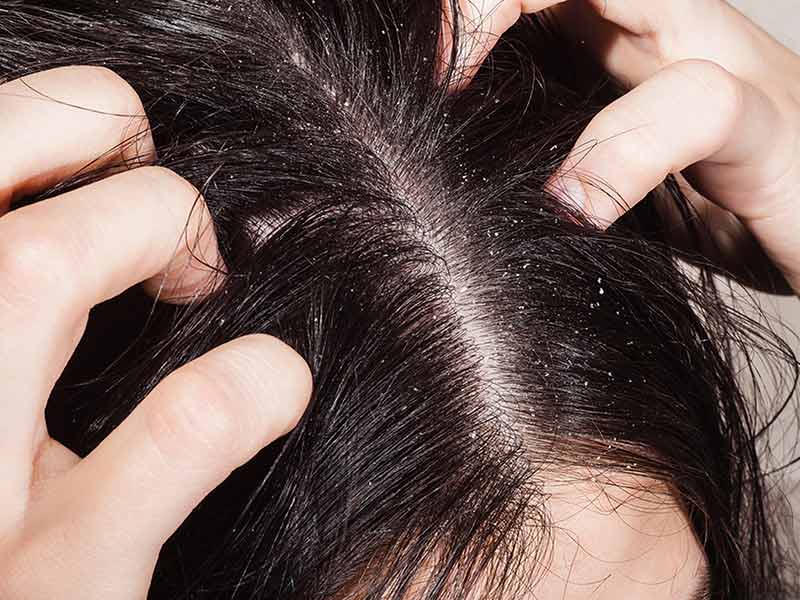 Can Dandruff Cause Hair Loss? Well... You Can Say 