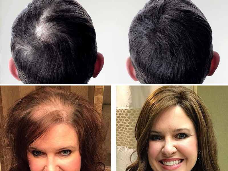 Can Dandruff Cause Hair Loss? Well... You Can Say "Yes" Or "No