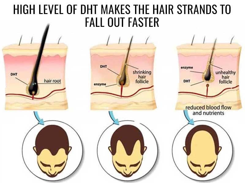 Loss testosterone to dht hair The Link