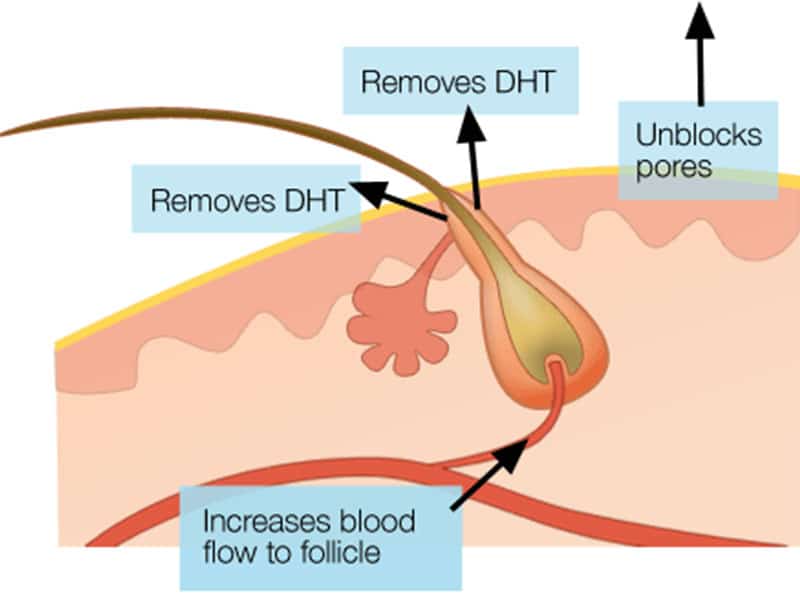 DHT Blockers - Is It A Viable Solution For Hair Loss?