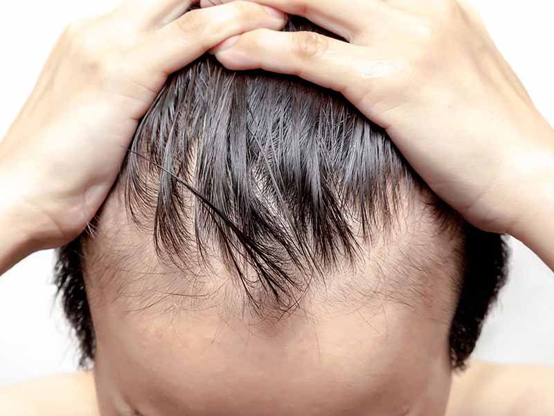 Hair Loss After Surgery: How To Grow Your Hair Back? - Lewigs