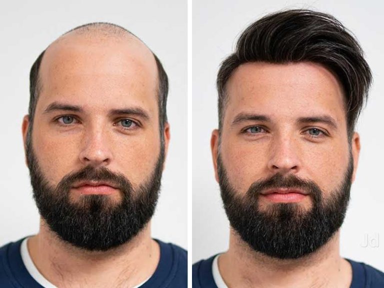 How To Get Thicker Hair Male