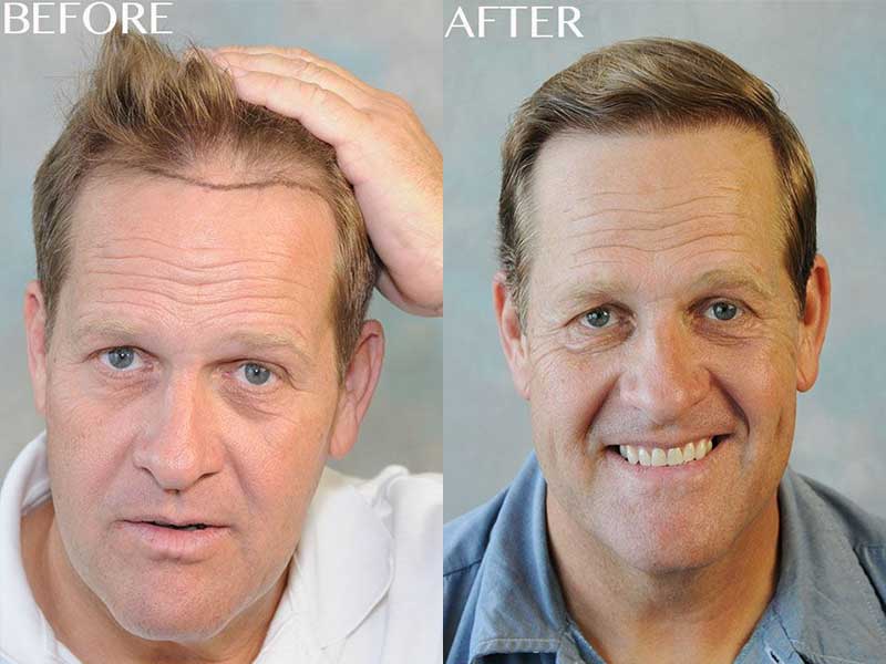What Is Neografting Hair Transplant And How Does It Work?