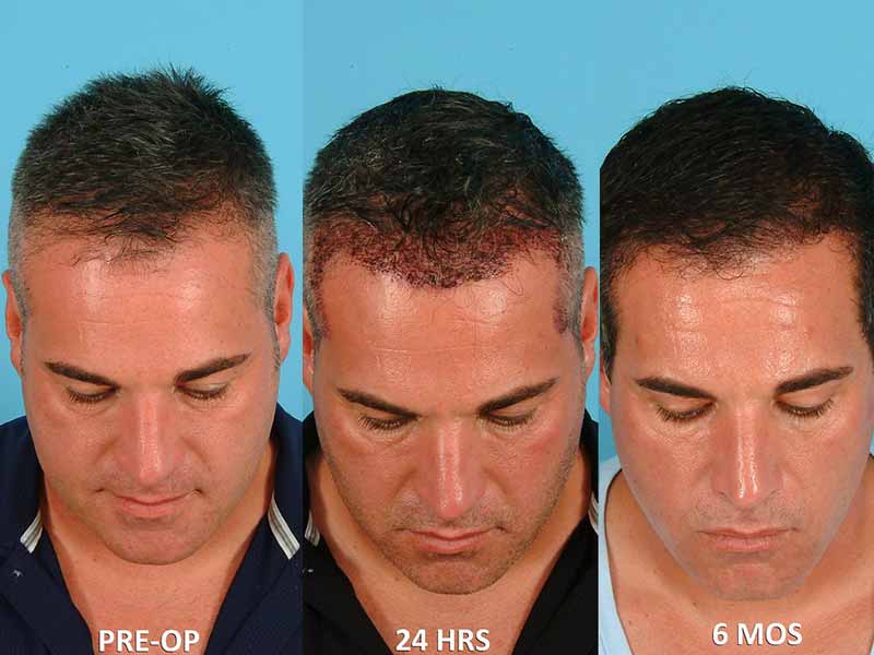 What Is Neografting Hair Transplant And How Does It Work?