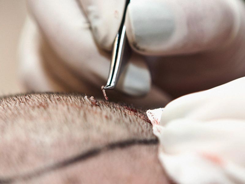 What Is Neografting Hair Transplant And How Does It Work?