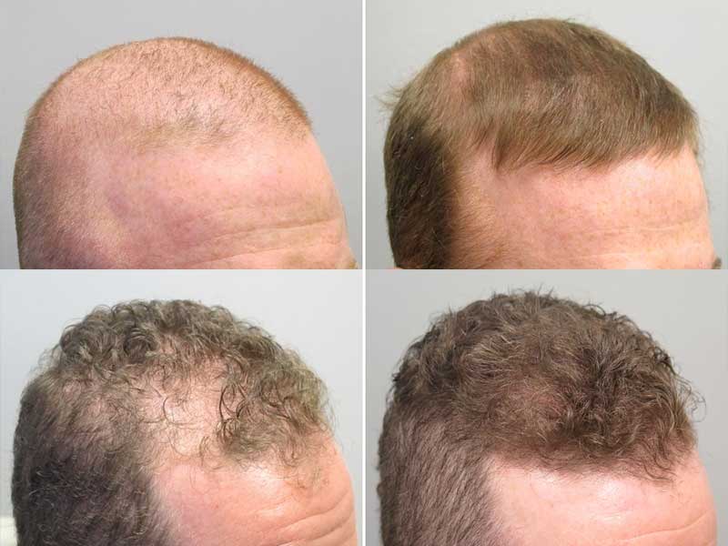 finasteride propecia proscar hair loss