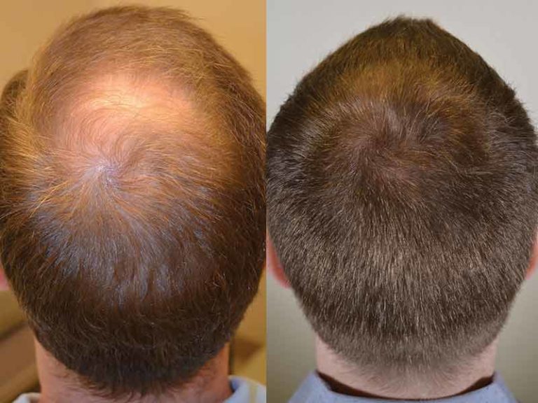 Могут ли выпадать волосы от приема тирозола