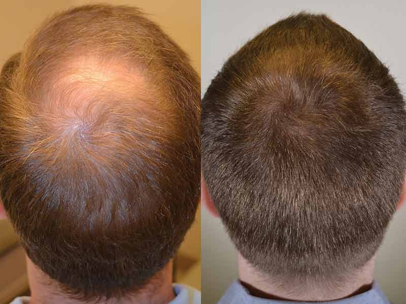 Dutasteride For Hair Loss: Is It A Feasible Solution?