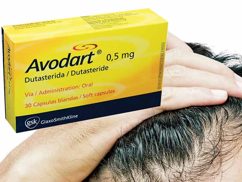 Dutasteride For Hair Loss: Is It A Feasible Solution?