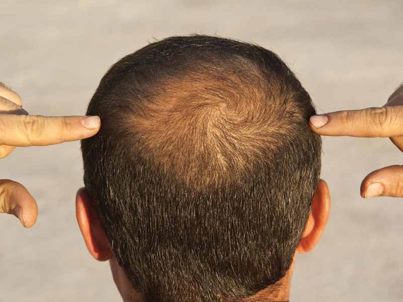 Signs Of Balding - How To Know If You're Going Bald?