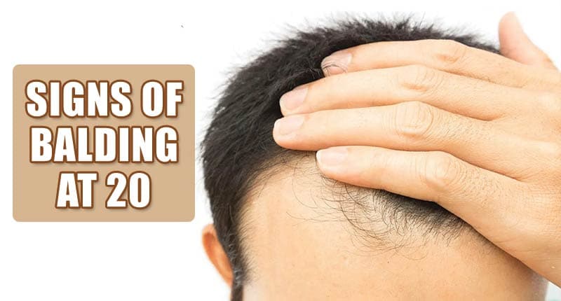 Signs Of Balding At 20: Are You Caught With Any?