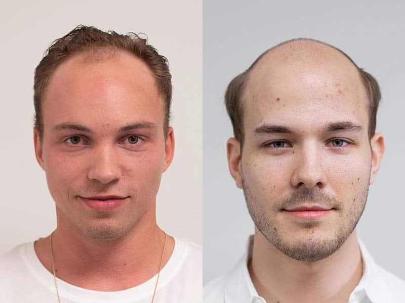 Signs Of Balding At 20: Are You Caught With Any?