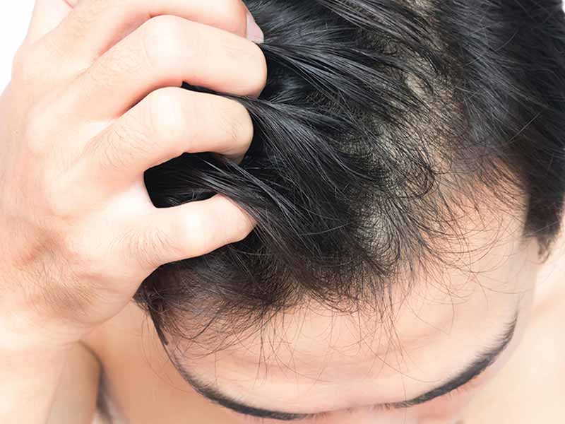Are You Experiencing These Signs Of Balding Male? | Lewigs