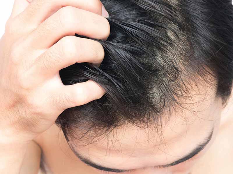 Are You Experiencing These Signs Of Balding Male?