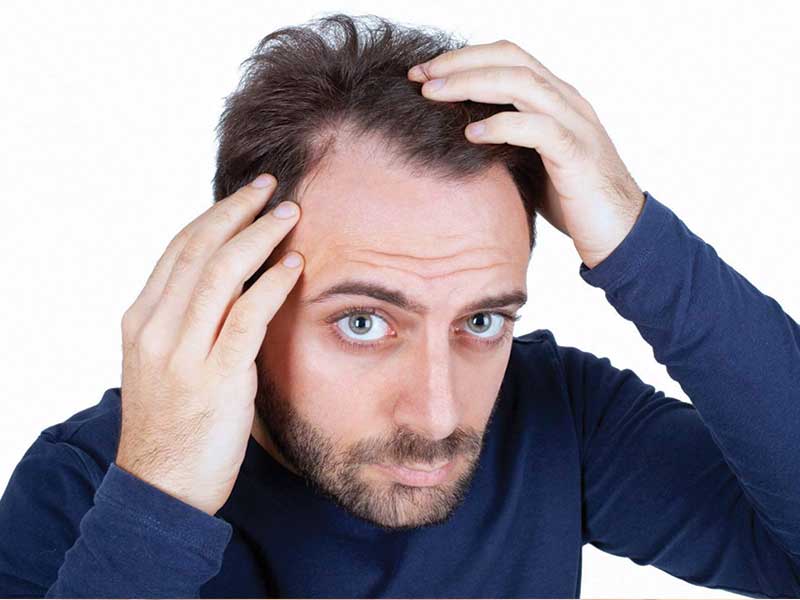 Are You Experiencing These Signs Of Balding Male?