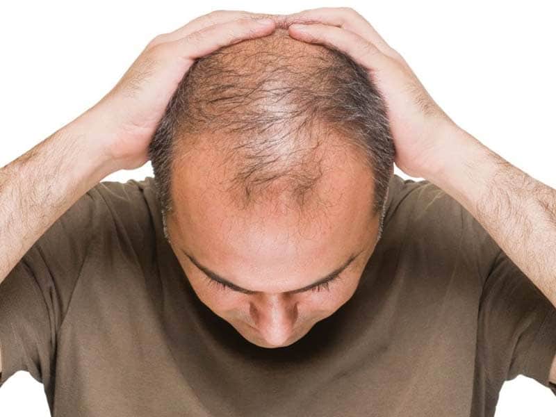 Are You Experiencing These Signs Of Balding Male?