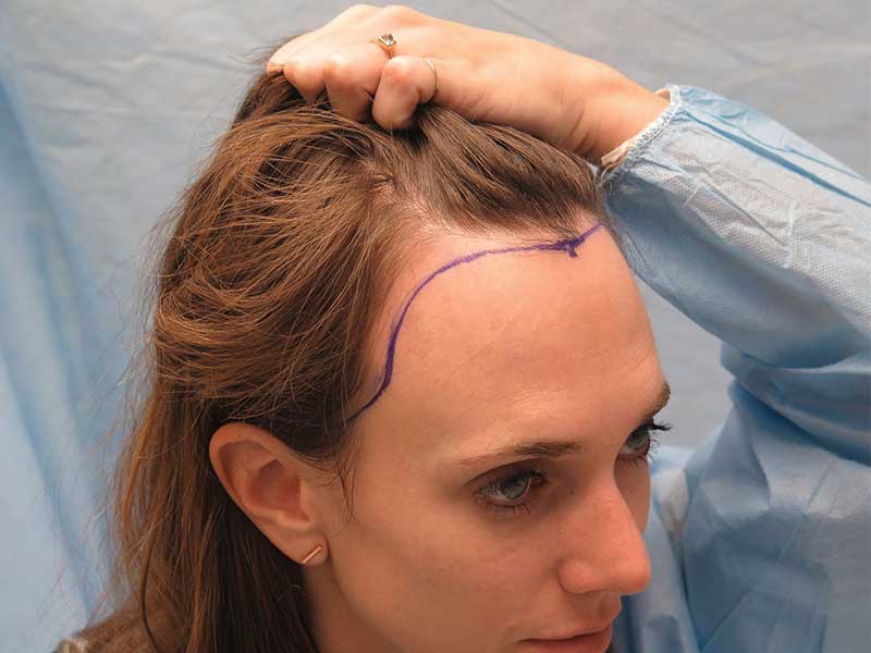What Are The Signs Of Balding In Female? receding hairline in young women. 