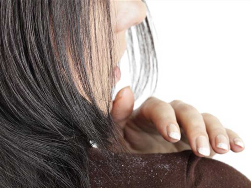 The Quickest Approach To Salicylic Acid Shampoo For Dandruff